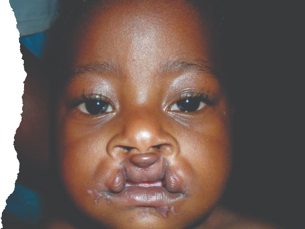 Oral Cancer Program